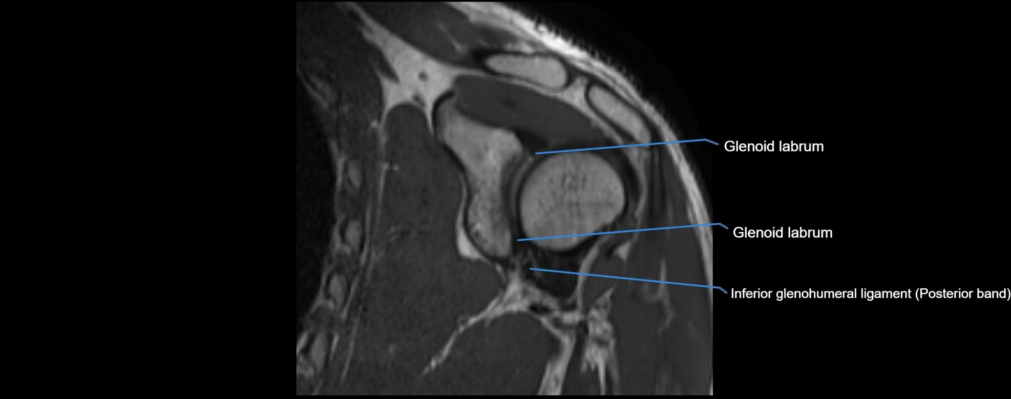 shoulder ligments coronal  cross sectional anatomy 3T MRI AI enhanced radiology image -img-00001-00029.webp